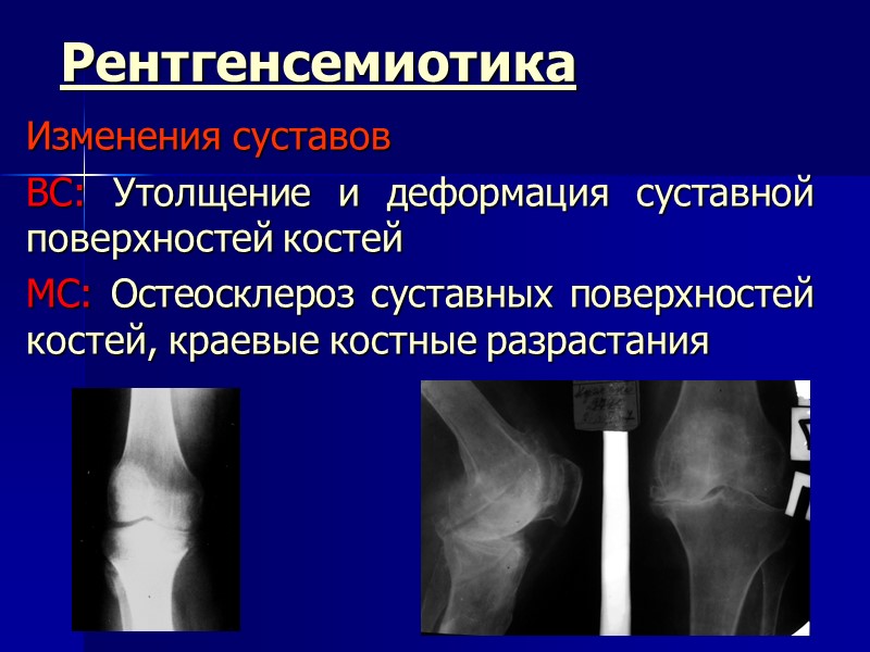 Рентгенсемиотика Изменения суставов ВС: Утолщение и деформация суставной поверхностей костей МС: Остеосклероз суставных поверхностей